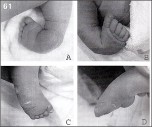  Врождённая косолапость и основы её лечения